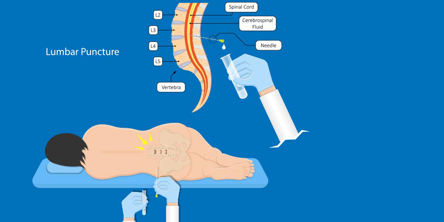 نمونه برداری از مایع مغزی نخاعی