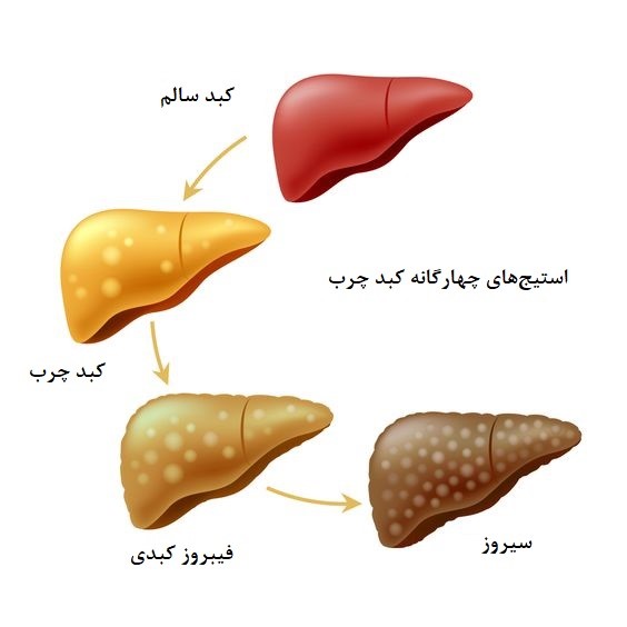 استیج و مراحل بیماری کبد چرب