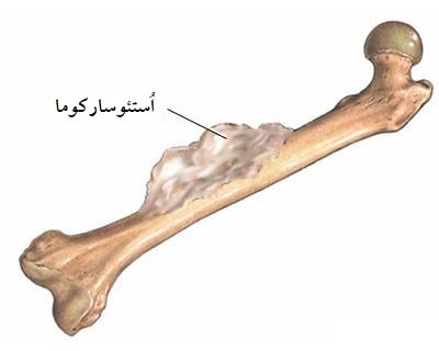 استئوسارکوما از انواع سرطان استخوان