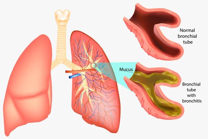 قسمتی از ریه که دچار برونشیت است