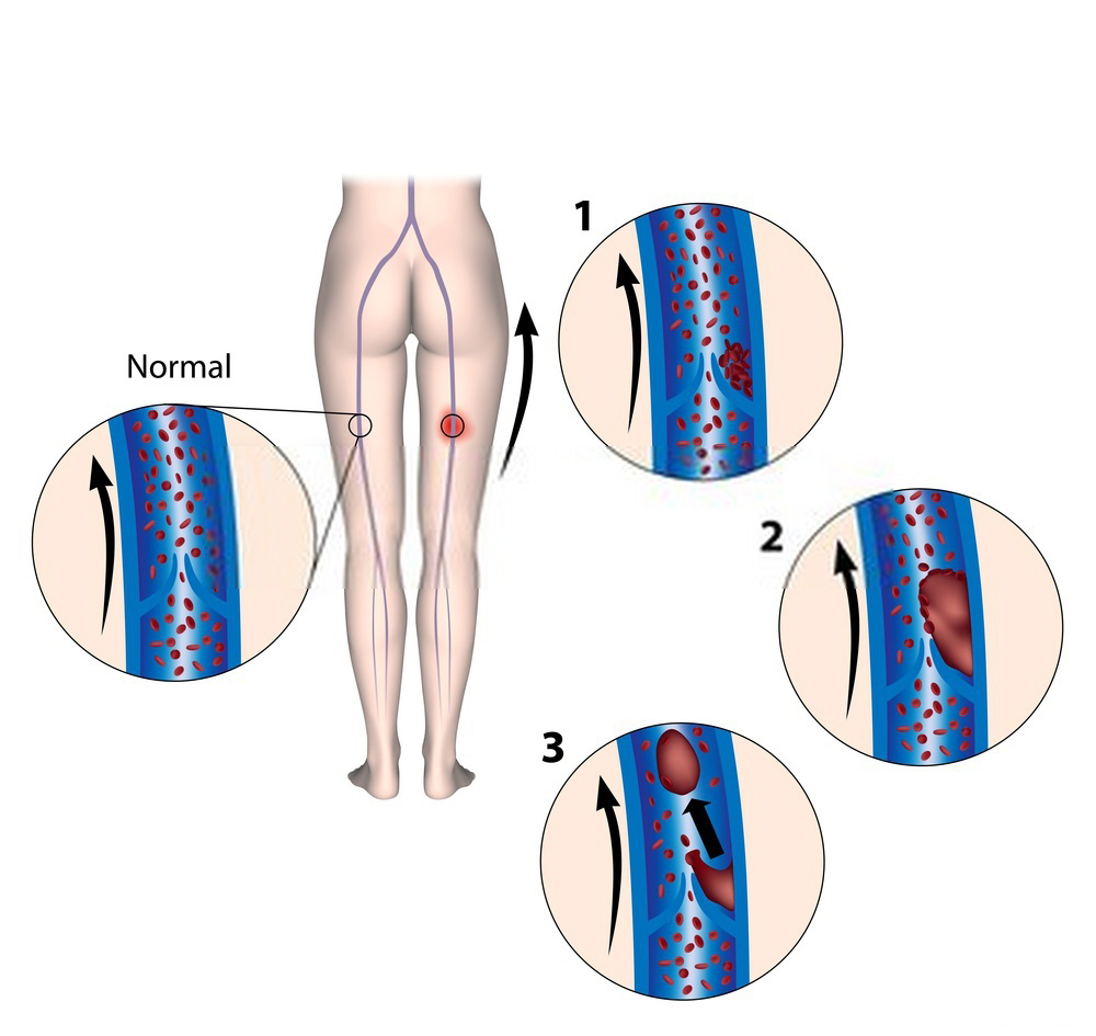 مراحل ترومبوز سیاهرگی عمقی