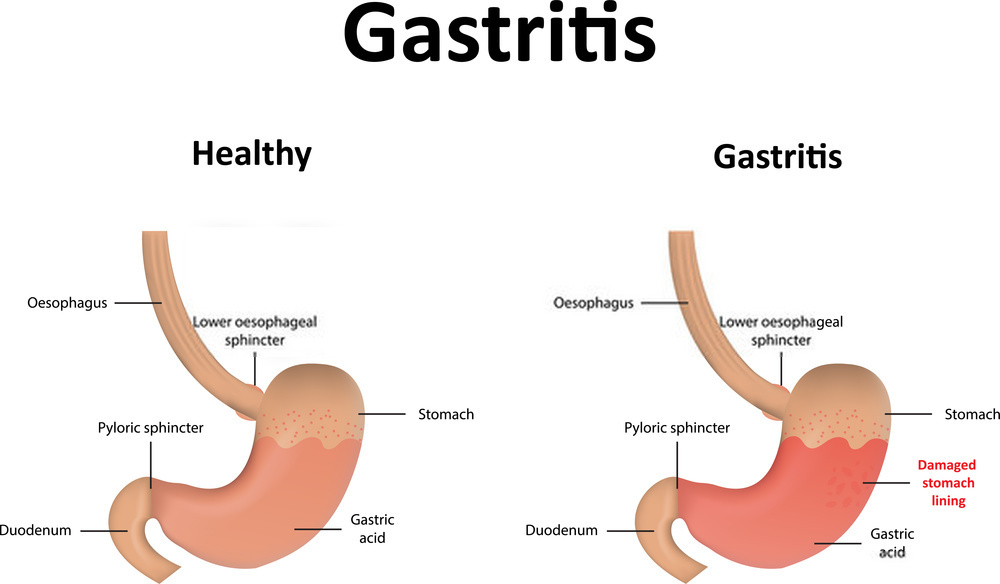 مقایسه گاستریت با معده سالم