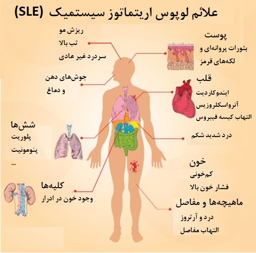 علائم لوپوس اریتماتوز سیستمیک