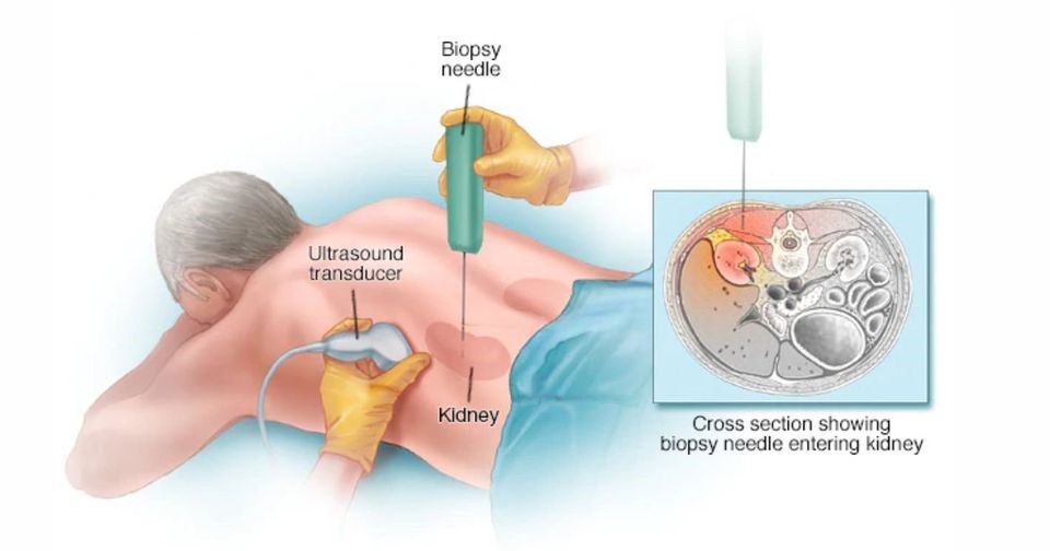 شماتیکی از مراحل بیوپسی کلیه
