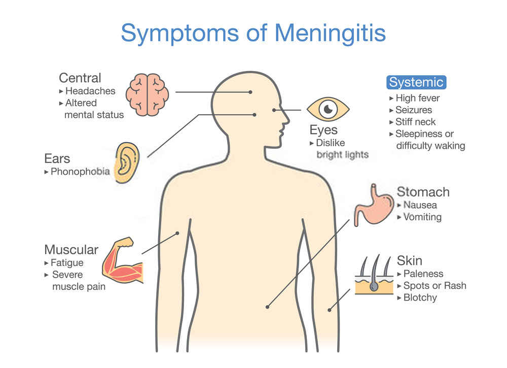 علائم ظاهری مننژیت