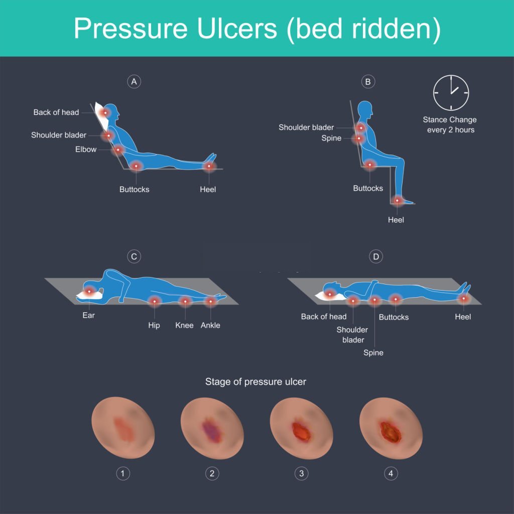 مراحل و راه های پیشگیری از زخم بستر