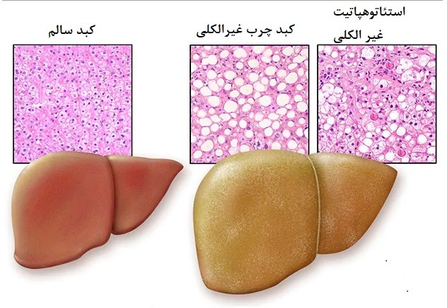 بیماری کبدچرب غیرالکلی